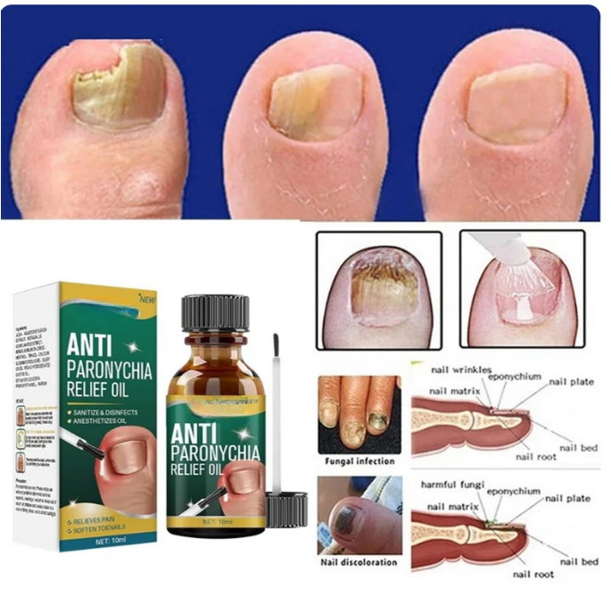 Anti Paronychia Relief Oil- Buy 1 Get 1 Free